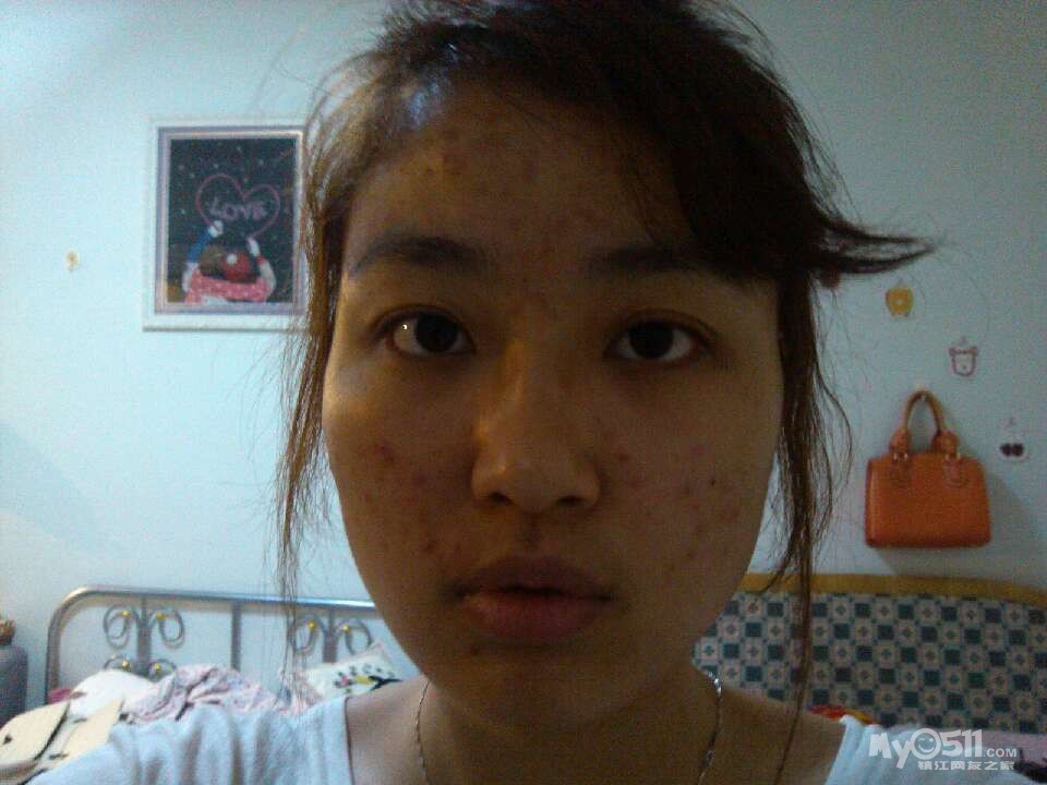 <em>粉刺</em> <em>痤疮</em> <em>青春痘</em> 痘印 痘坑 - 健康美容 - 梦溪论