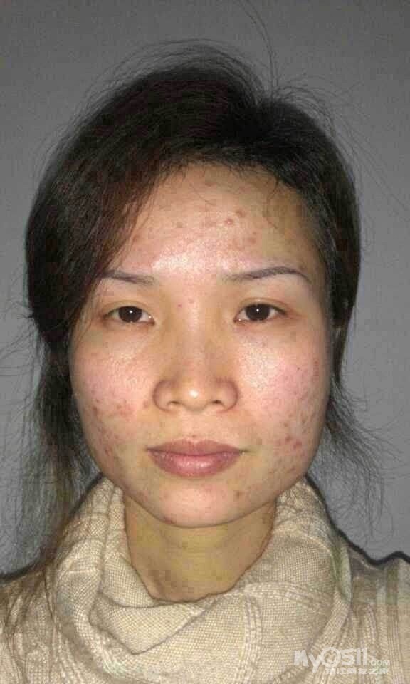 右脸老是<em>长痘痘,怎么办</em> - 女性天地 - 梦溪论坛 