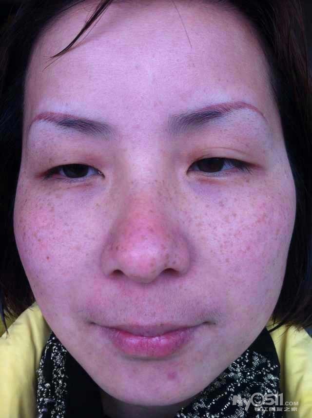 伊媚尔--- 祛斑 脱毛 祛痣 专业治疗问题性皮肤 