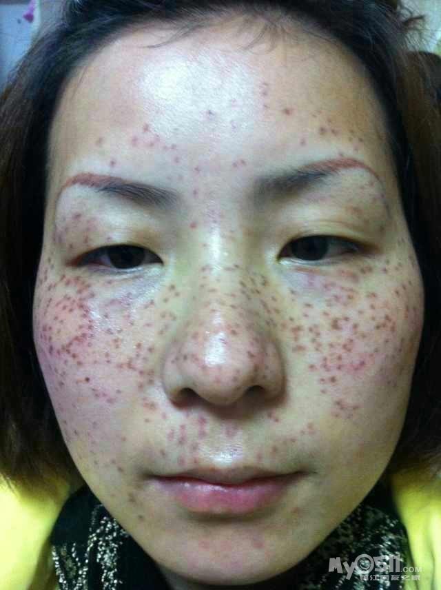 伊媚尔--- 祛斑 脱毛 祛痣 专业治疗问题性皮肤 