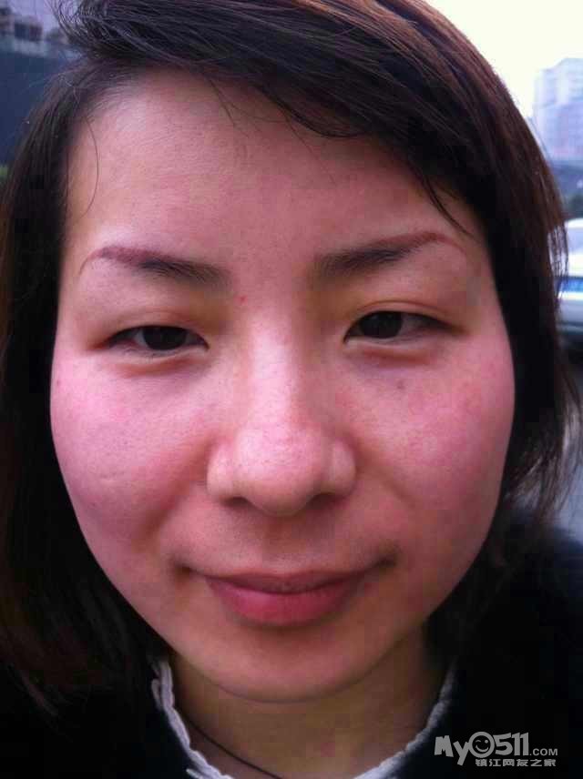 伊媚尔--- 祛斑 脱毛 祛痣 专业治疗问题性皮肤 