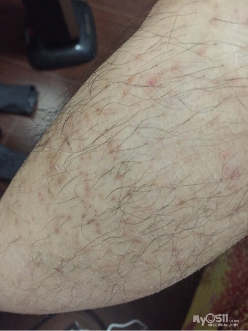 腿上有红点怎么回事 - 百姓话题 - 梦溪论坛 镇江