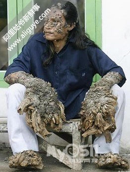 10种确实存在的变异人类[重口味],慎入