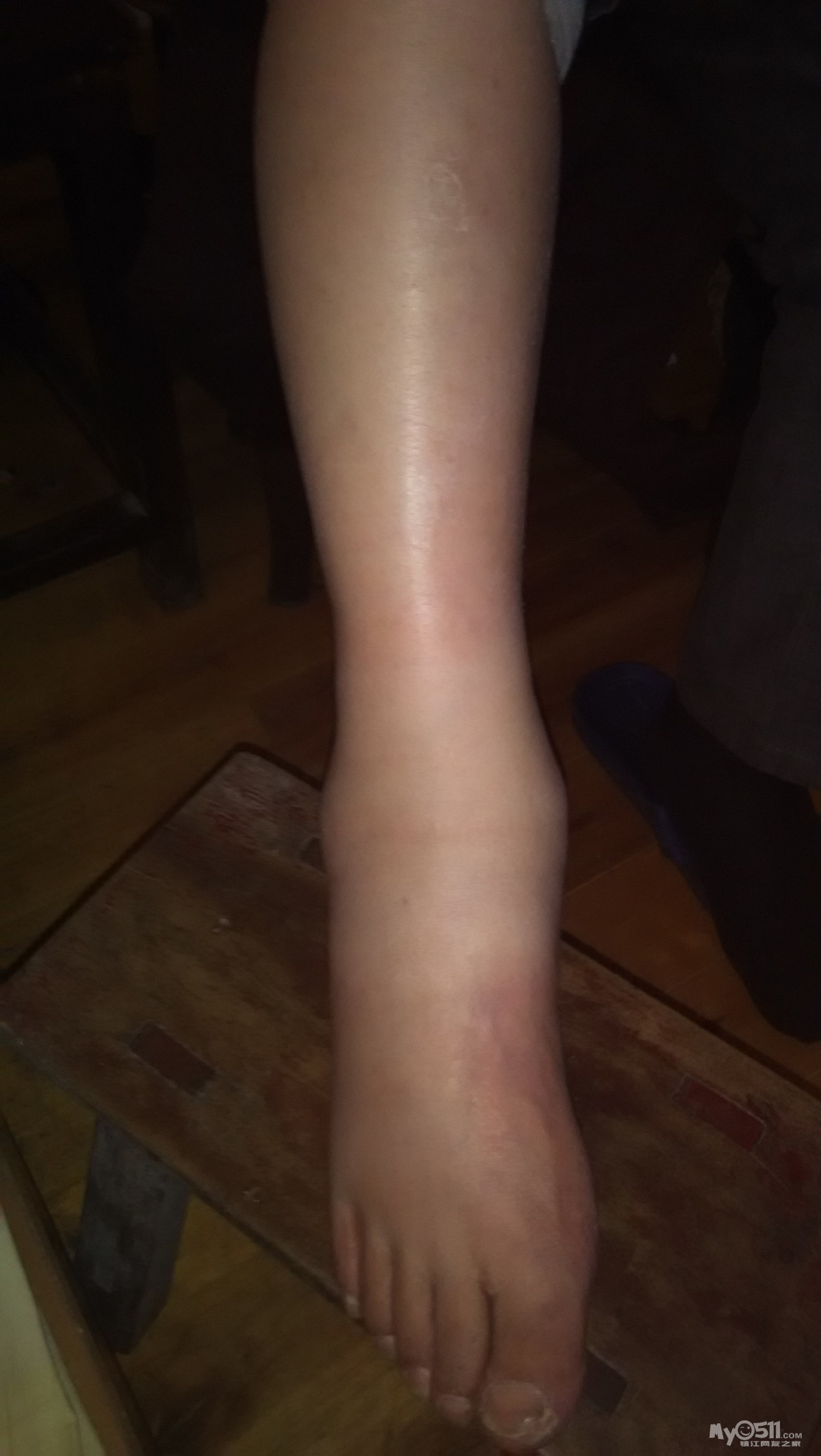 中风的腿也开始肿了.