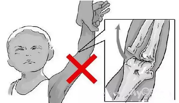 牵拉肘是什么情况?请看上面这张图.