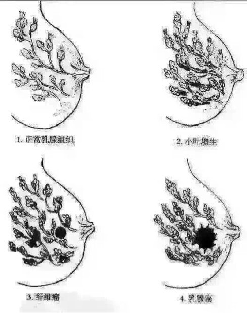乳腺增生的困扰
