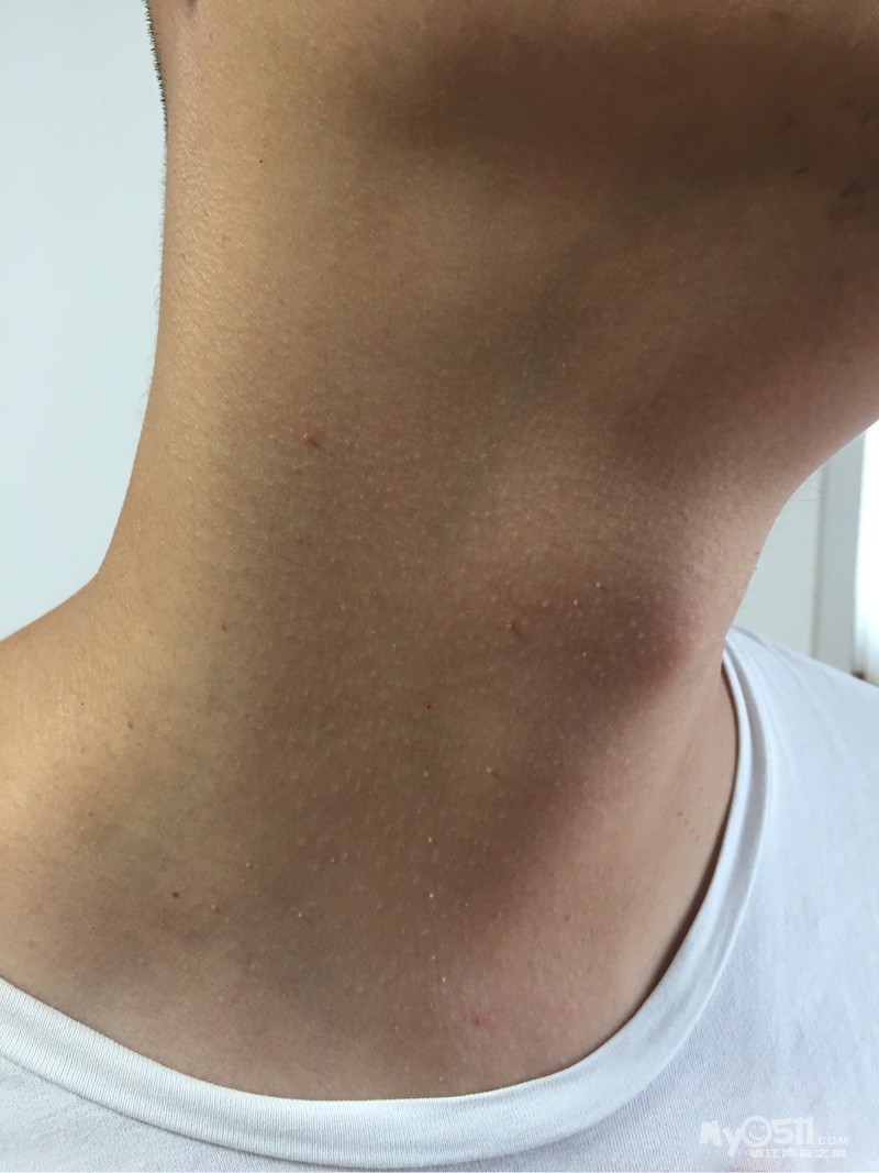 脖子上长了米粒大小的东西