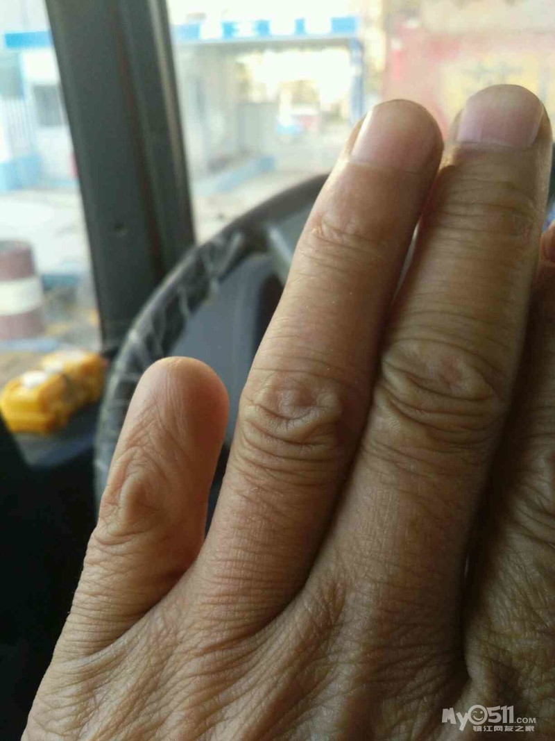 因家事老父刀剁自己小拇指 女儿手捧断指急追民警冰镇"救活"