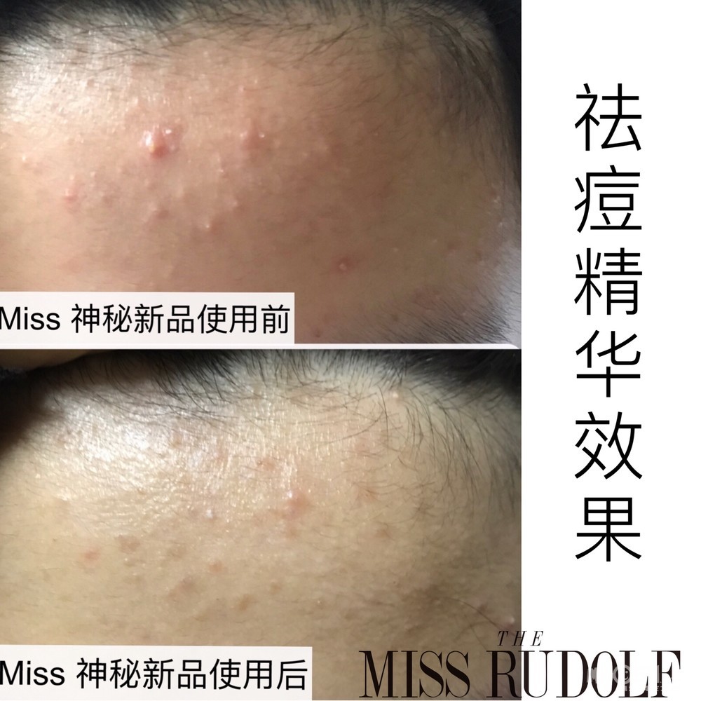 怎样才能不长闭口粉刺 qn_1584586862557053150rs.jpg